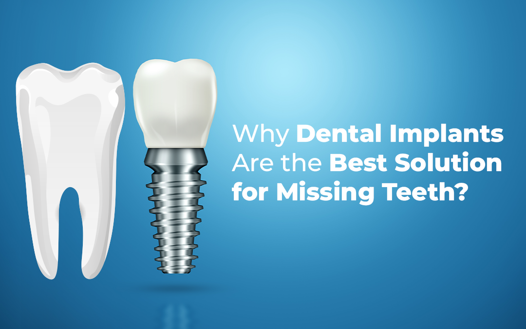 Why Dental Implants Are the Best Solution for Missing Teeth